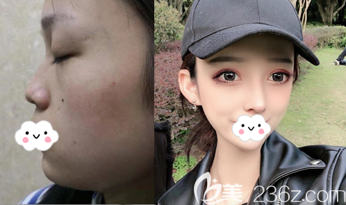 成都西區(qū)醫(yī)院鄧東偉肋軟骨鼻綜合術(shù)后效果圖