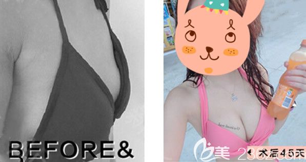 蘭州時光乳房下垂矯正效果怎么樣