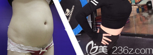 成都西區(qū)醫(yī)院毛健清腰腹吸脂術(shù)前術(shù)后對比 