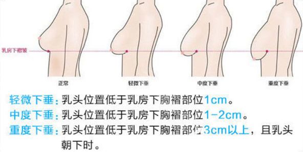 乳房下垂的級別