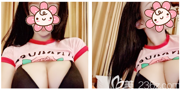 讓剛找廣州韓妃于洪瑞做完自體脂肪豐胸的我來(lái)告訴你廣州隆胸豐胸哪家醫(yī)院好