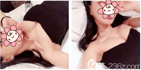 廣州韓妃隆胸案例兩個月躺下來的效果圖 廣州韓妃隆胸案例兩個月躺下來的效果圖