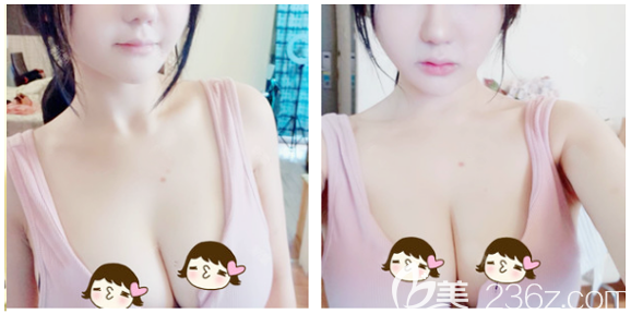 看廣州韓妃做自體脂肪隆胸效果怎么樣 看廣州韓妃做自體脂肪隆胸效果怎么樣