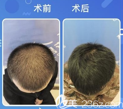 深圳碧蓮盛BHT2.0頭頂加密種植效果