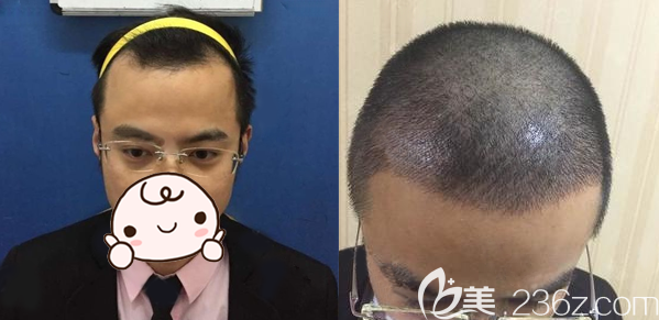 北京壹加壹郝文義額角種植術(shù)前術(shù)后對(duì)比療效 北京壹加壹郝文義額角種植術(shù)前術(shù)后對(duì)比療效