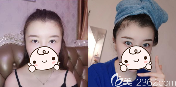 通過郝文義2個植發(fā)案例及技術(shù)優(yōu)勢分析了解北京壹加壹毛囊種植醫(yī)院到底怎么樣