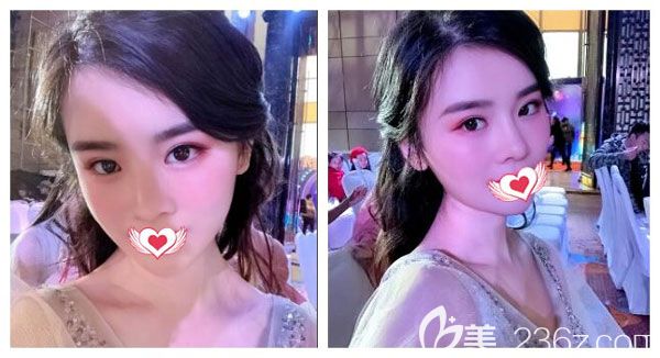 南寧愛思特超皮秒祛斑的術(shù)后效果圖