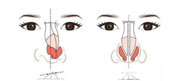 愛思特整形王楷做鼻子怎么樣呢 愛思特整形王楷做鼻子怎么樣呢