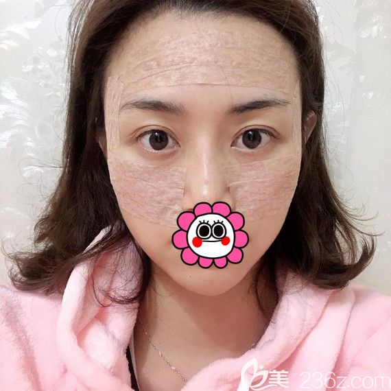 寧波薇琳做自體脂肪填充面部術(shù)后即刻