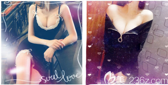 看了東莞南城十大整形醫(yī)院排名后找正規(guī)可靠的東莞壹加壹王擎做了自體脂肪隆胸