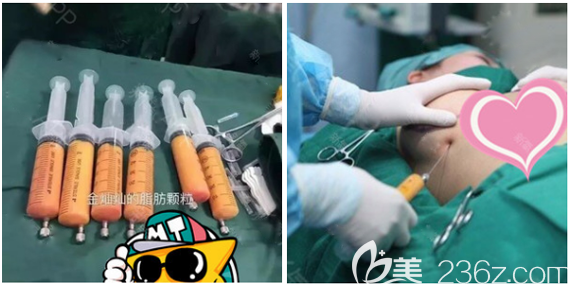 東莞壹加壹王摯隆胸手術(shù)過(guò)程圖 東莞壹加壹王摯隆胸手術(shù)過(guò)程圖