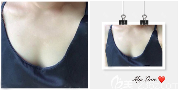 在東莞壹加壹整形醫(yī)院隆胸術(shù)前照片 在東莞壹加壹整形醫(yī)院隆胸術(shù)前照片