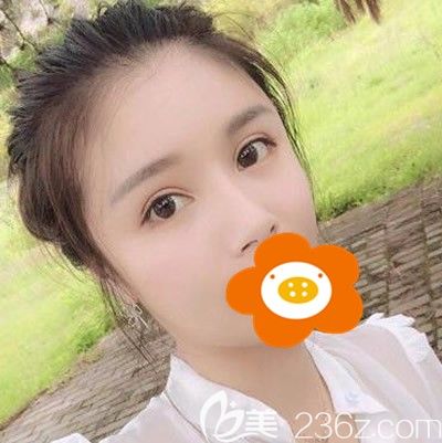 術后一個月脂肪成活很不錯