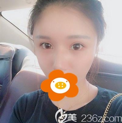 自體脂肪豐全臉術后半個月，臉還有點微腫