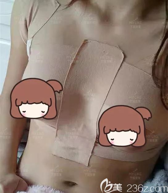 寧波美萊假體隆胸術(shù)后7天到醫(yī)院復(fù)查