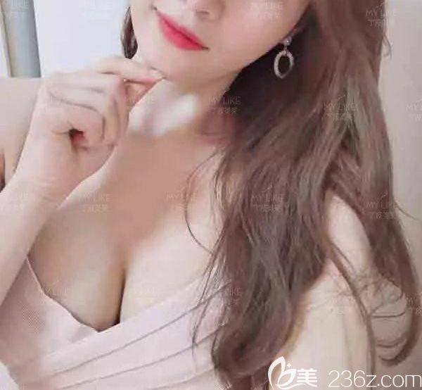 寧波美萊姚遠(yuǎn)假體隆胸效果怎么樣