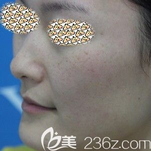 困擾多年的遺傳性雀斑選擇合肥藝星做皮秒激光終于給解決掉了，看我術后10-30天的變化圖