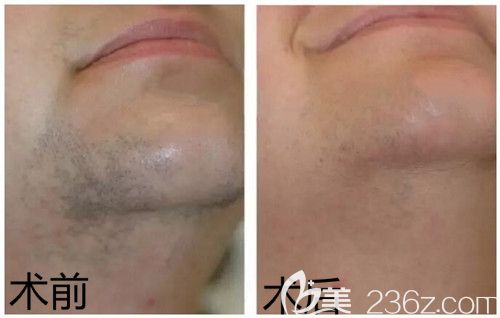 周口締萊美冰點(diǎn)脫毛去胡子案例