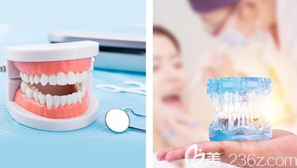 兒童窩溝封閉首顆免費 兒童窩溝封閉首顆免費