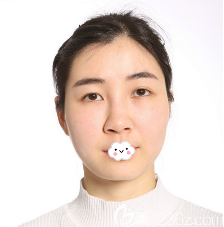 找廣州紫馨王永功做鼻子術(shù)前照片 找廣州紫馨王永功做鼻子術(shù)前照片