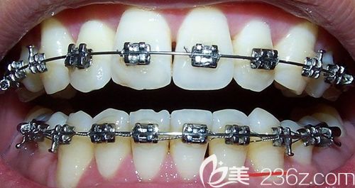 張猛醫(yī)生講解正畸中方弓絲和直弓絲及功能性矯治技術的區(qū)別 張猛醫(yī)生講解正畸中方弓絲和直弓絲及功能性矯治技術的區(qū)別