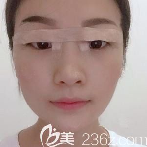 林勇完雙眼皮術(shù)后<span style=