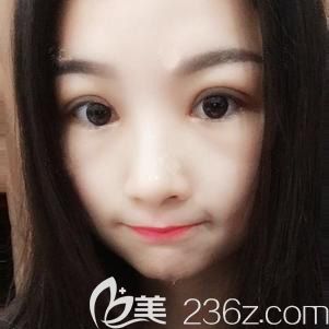 雙眼皮術(shù)后恢復(fù)十天