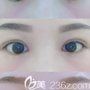 恢復(fù)二十天的雙眼皮<span style=