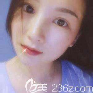 曬一下我在寧波壹加壹找林勇做的全切雙眼皮一個月恢復(fù)過程圖