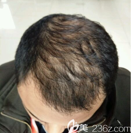 植發(fā)手術(shù)前的照片 植發(fā)手術(shù)前的照片