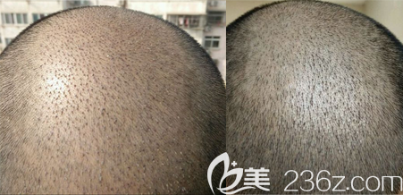 植發(fā)術(shù)后第5天和9天清洗血痂角質(zhì)對比 植發(fā)術(shù)后第5天和9天清洗血痂角質(zhì)對比