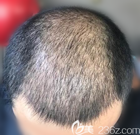 <!--<i data=20240703-sp></i>-->張橋植發(fā)案例一個月效果 <!--<i data=20240703-sp></i>-->張橋植發(fā)案例一個月效果