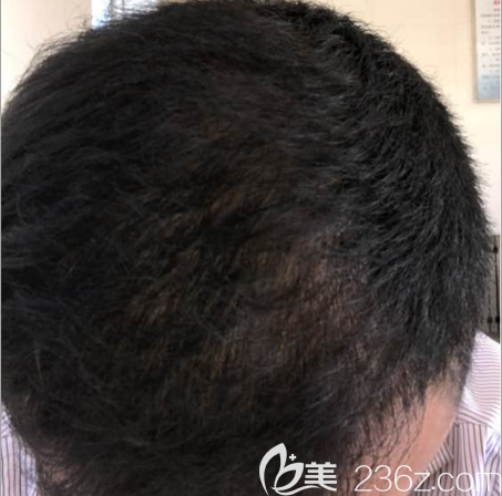 <!--<i data=20240703-sp></i>-->植發(fā)4個月照片 <!--<i data=20240703-sp></i>-->植發(fā)4個月照片