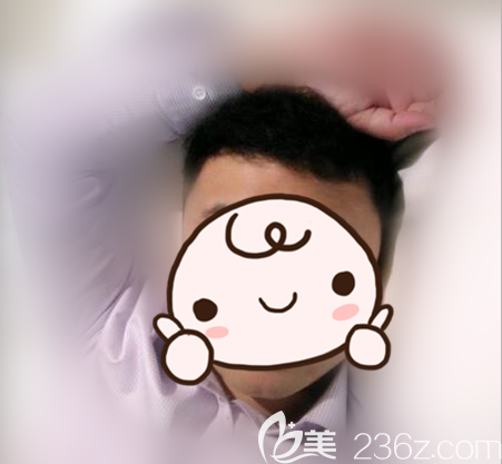 開個帖子記錄下我在找張橋醫(yī)生大面積植發(fā)4200單位的11個月的恢復(fù)效果