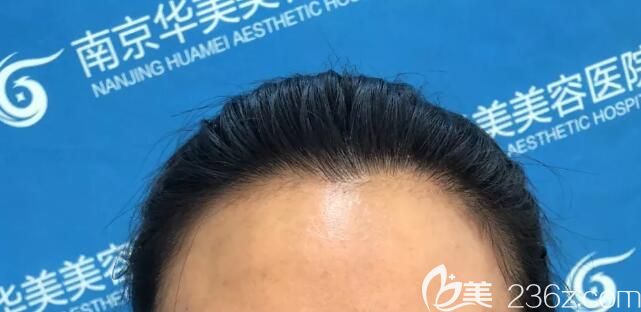 術(shù)前凹陷的額頭 術(shù)前凹陷的額頭