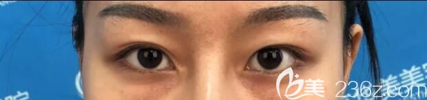 面診南京華美前凹陷的太陽穴 面診南京華美前凹陷的太陽穴