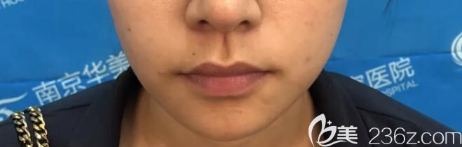 術(shù)前凹陷的面頰 術(shù)前凹陷的面頰