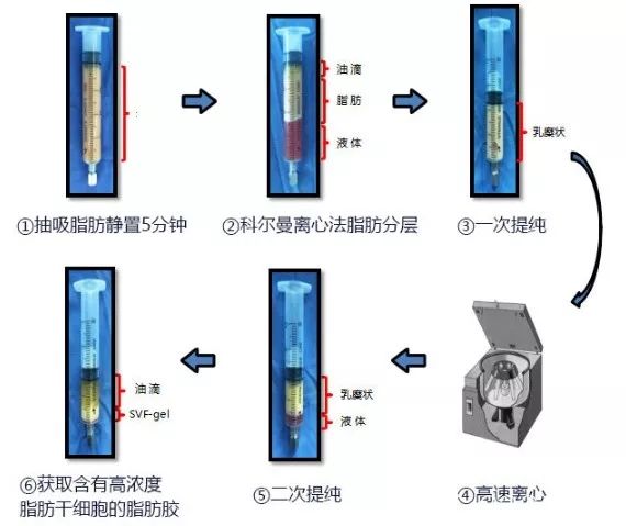 南京華美脂肪移植原理 南京華美脂肪移植原理