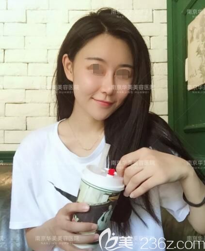 術(shù)后一周脂肪移植恢復(fù)腫脹中 術(shù)后一周脂肪移植恢復(fù)腫脹中