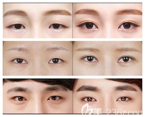 駐馬店美蘭德割雙眼皮療效圖