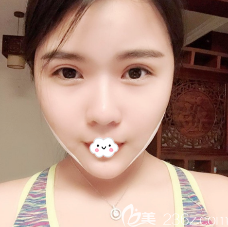 在廣州紫馨做完雙眼皮失敗修復(fù)15天自拍