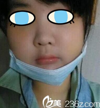 <!--<i data=20240703-sp></i>-->面部輪廓整形案例