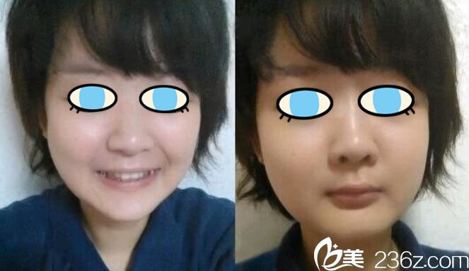 <!--<i data=20240703-sp></i>-->雙鄂手術恢復過程圖