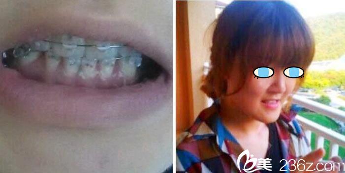 <!--<i data=20240703-sp></i>-->雙鄂手術術后6周恢復效果圖