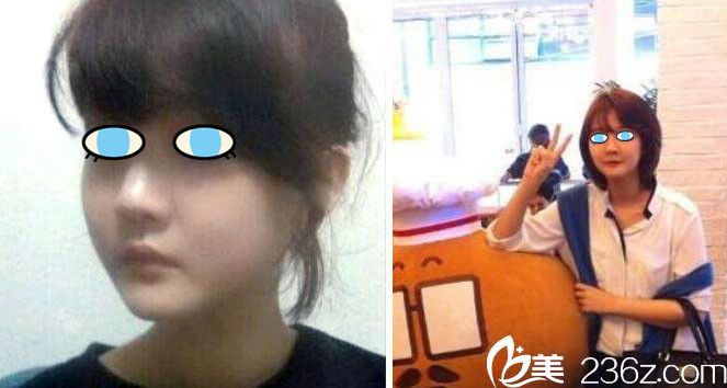 武漢磨骨哪家醫(yī)院好？五洲萊美雙鄂手術案例