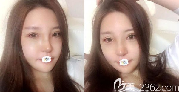 韓國(guó)原辰整形醫(yī)院輪廓術(shù)后1周恢復(fù)效果圖