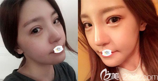 韓國(guó)原辰整形醫(yī)院雙眼皮開眼角+鼻綜合隆鼻+假體隆胸案例