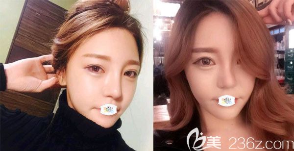 趁韓國原辰整形醫(yī)院價格表有優(yōu)惠活動做眼鼻胸+輪廓三件套后感慨整形的重要性！