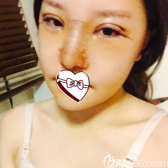 韓國(guó)原辰整形醫(yī)院眼鼻+面部輪廓整形案例