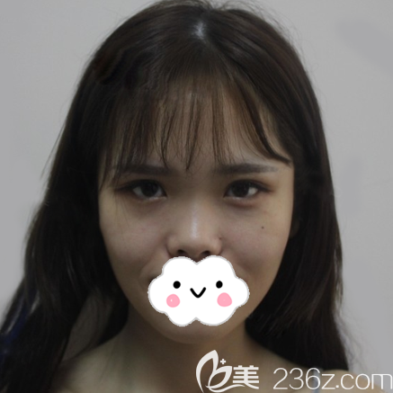 找黃富偉做鼻子前的照片 找黃富偉做鼻子前的照片